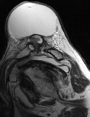 Figure 4 for case Large cyst above a degenerated acromioclavicular joint ( RID1895 )